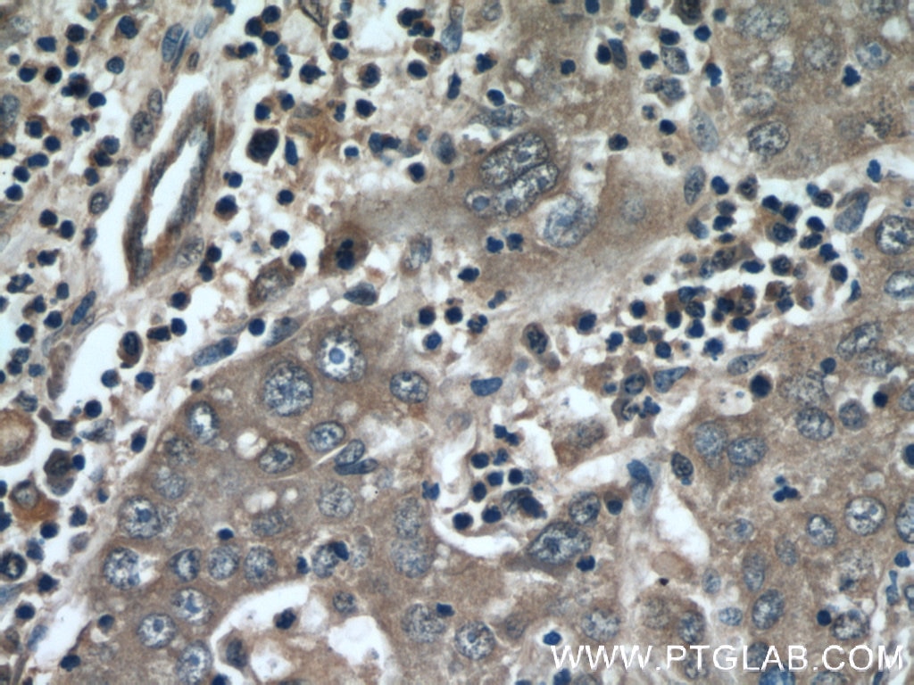 Immunohistochemistry (IHC) staining of human liver cancer tissue using MMP20 Polyclonal antibody (55467-1-AP)