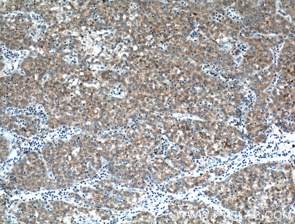 Immunohistochemistry (IHC) staining of human liver cancer tissue using MMP23B Polyclonal antibody (13020-1-AP)