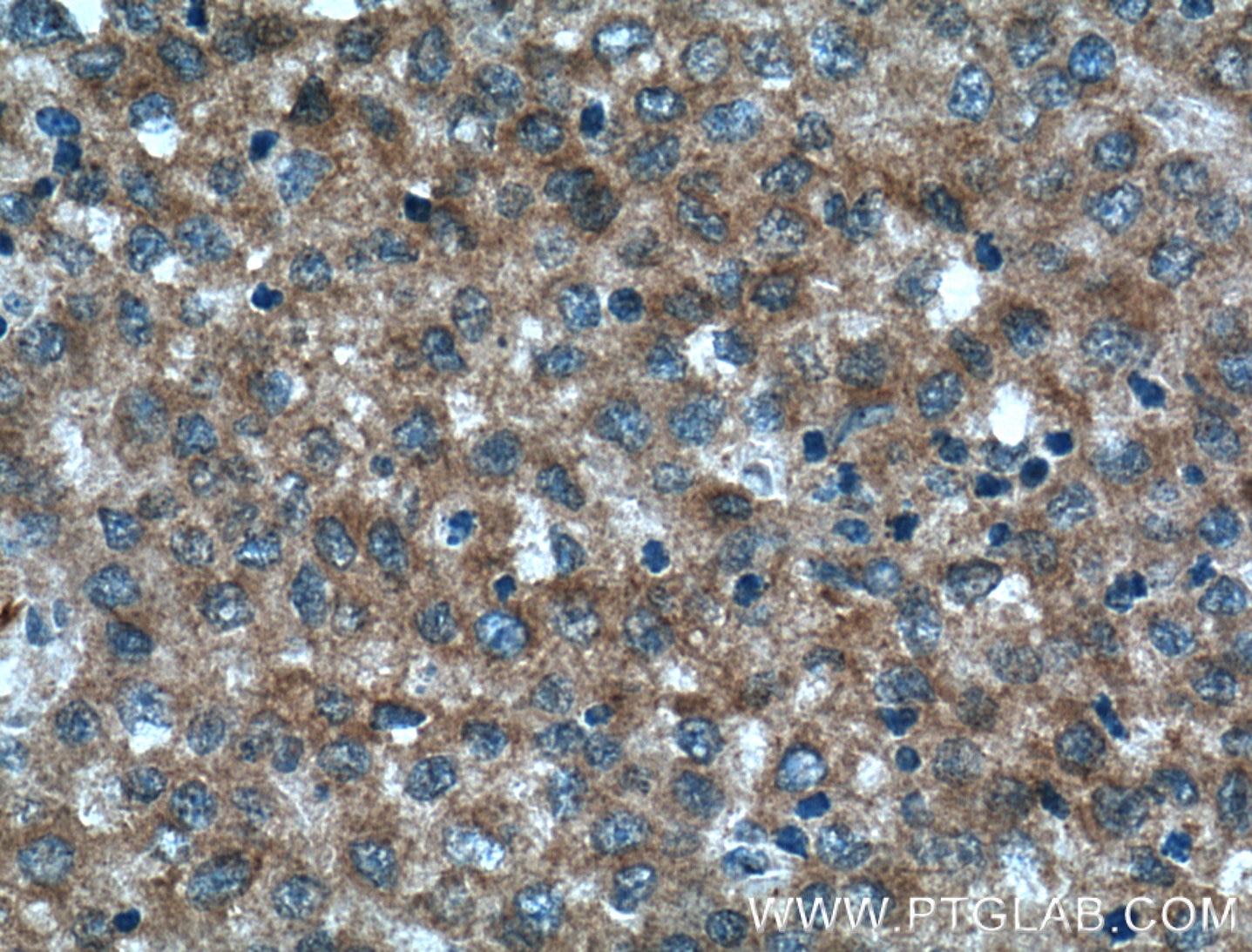 Immunohistochemistry (IHC) staining of human liver cancer tissue using MMP23B Polyclonal antibody (13020-1-AP)
