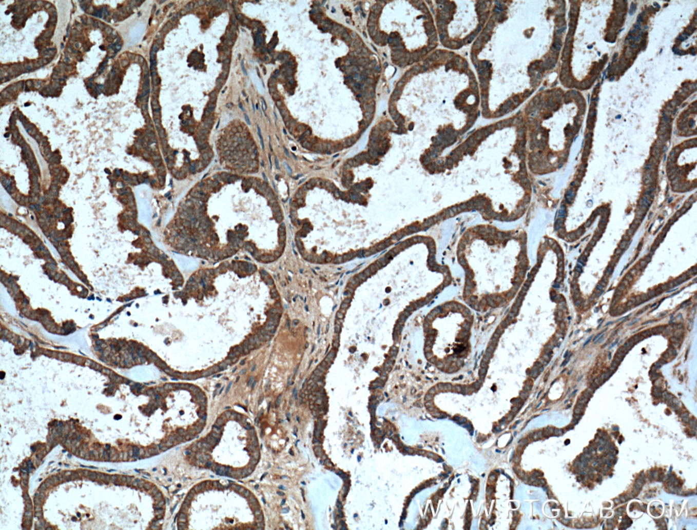 Immunohistochemistry (IHC) staining of human ovary tumor tissue using MMP23B Polyclonal antibody (13020-1-AP)