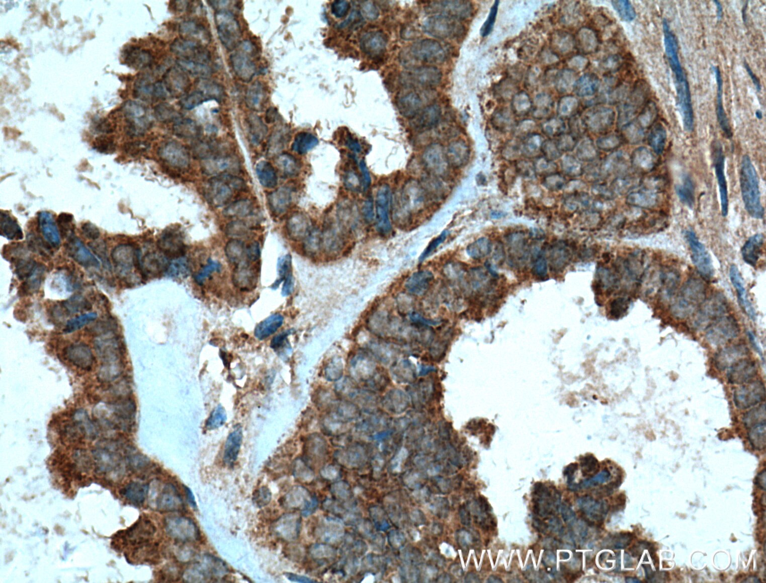 Immunohistochemistry (IHC) staining of human ovary tumor tissue using MMP23B Polyclonal antibody (13020-1-AP)