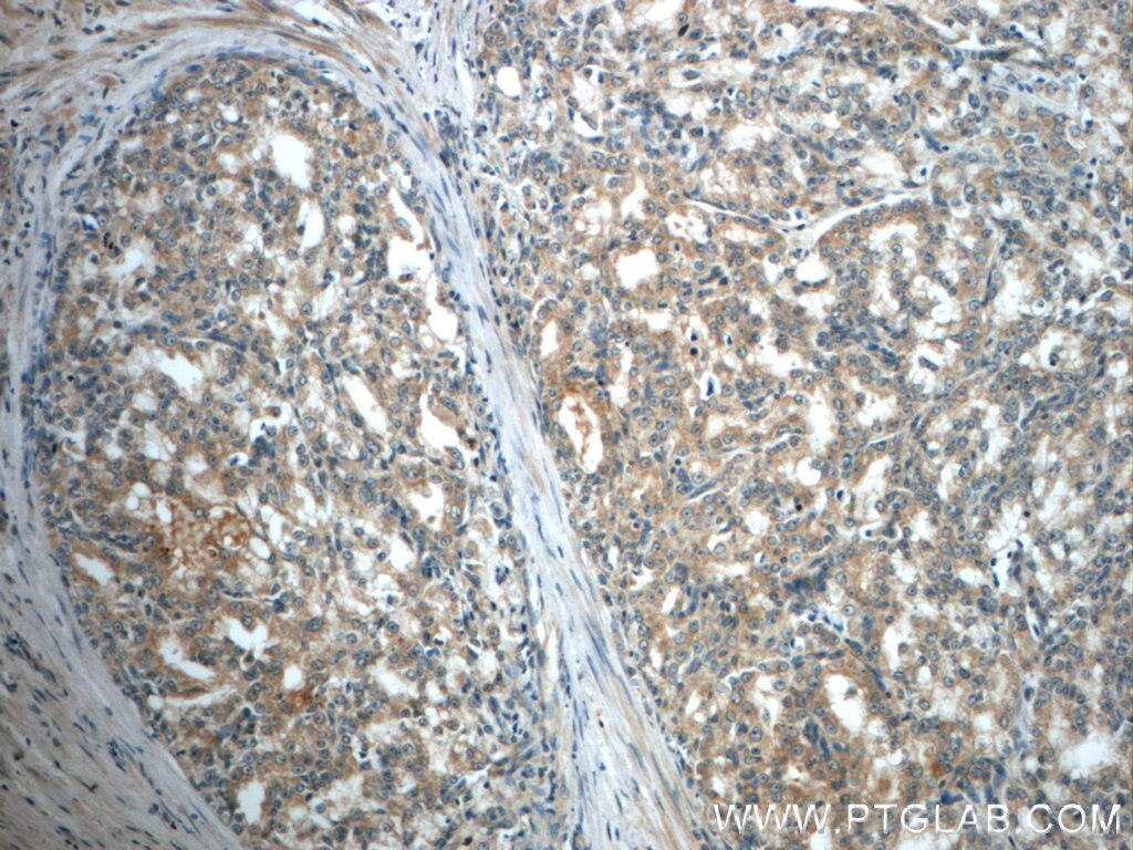 Immunohistochemistry (IHC) staining of human prostate cancer tissue using MMP26 Polyclonal antibody (18087-1-AP)