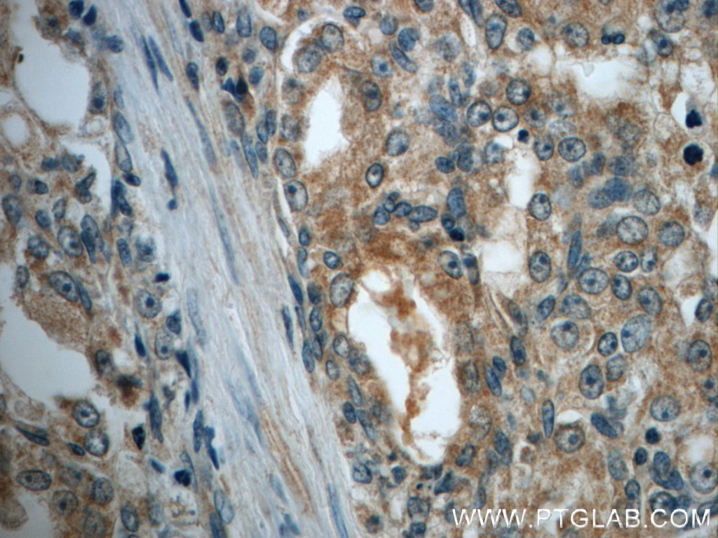 Immunohistochemistry (IHC) staining of human prostate cancer tissue using MMP26 Polyclonal antibody (18087-1-AP)