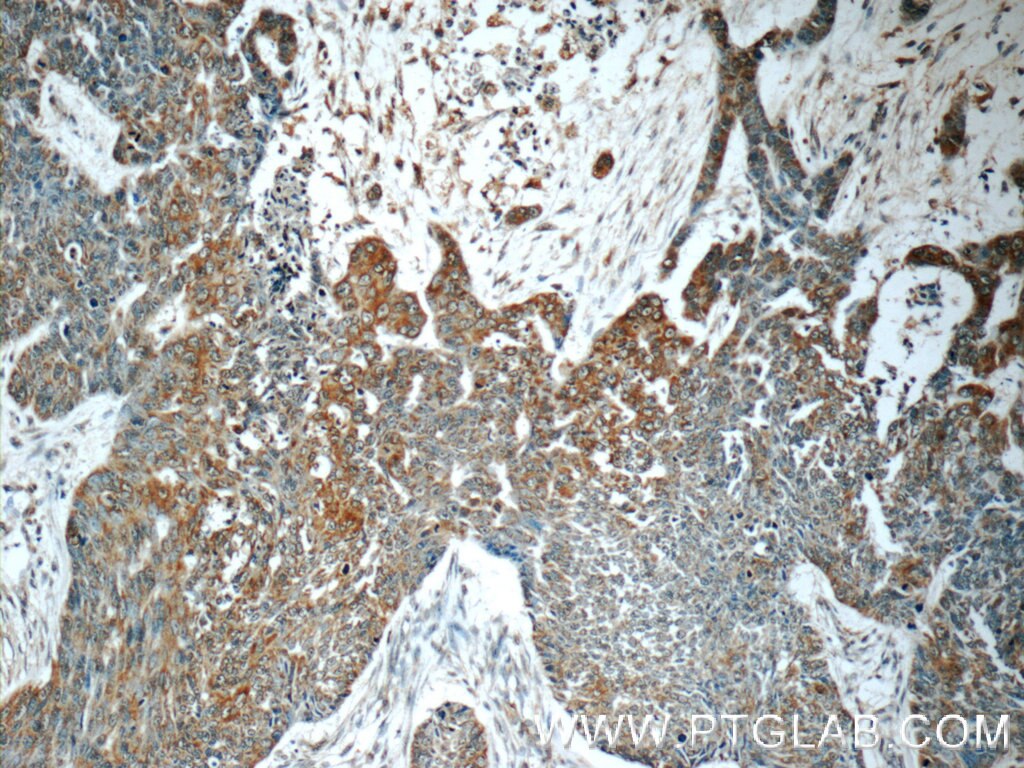 Immunohistochemistry (IHC) staining of human skin cancer tissue using MMP28 Polyclonal antibody (18237-1-AP)