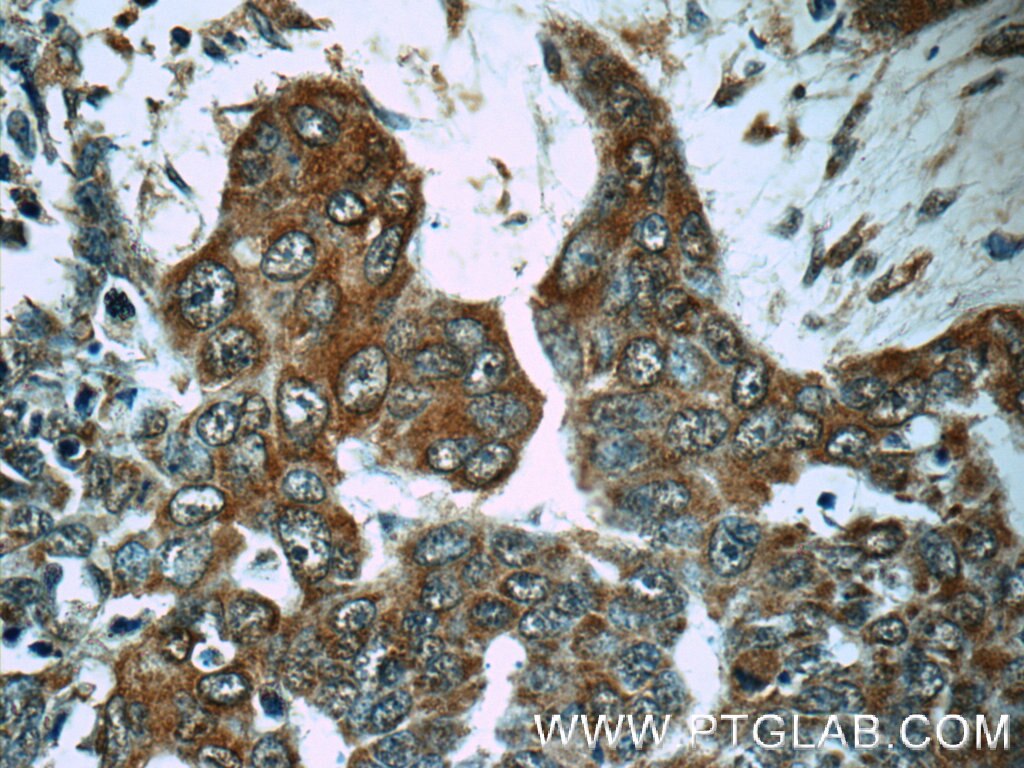 Immunohistochemistry (IHC) staining of human skin cancer tissue using MMP28 Polyclonal antibody (18237-1-AP)