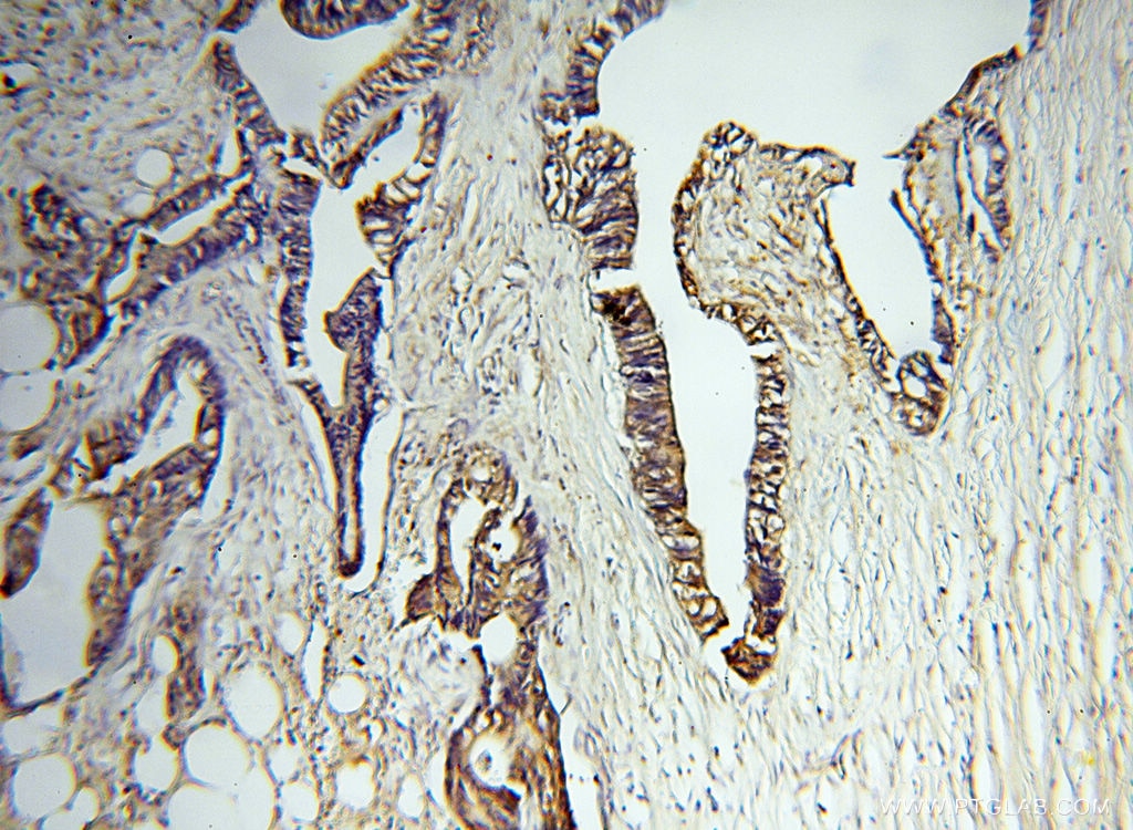 Immunohistochemistry (IHC) staining of human breast cancer tissue using MMP3 Polyclonal antibody (17873-1-AP)