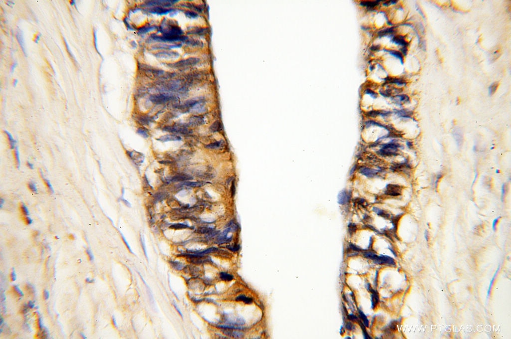 Immunohistochemistry (IHC) staining of human breast cancer tissue using MMP3 Polyclonal antibody (17873-1-AP)