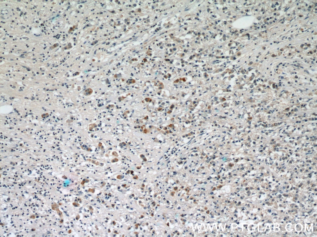 Immunohistochemistry (IHC) staining of human breast cancer tissue using MMP3 Polyclonal antibody (17873-1-AP)