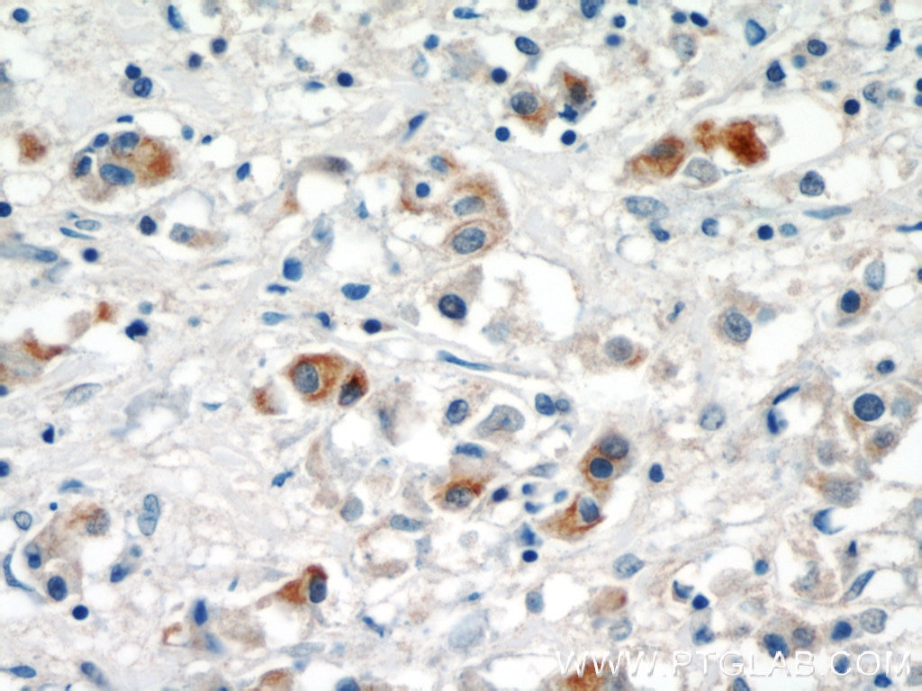 Immunohistochemistry (IHC) staining of human breast cancer tissue using MMP3 Polyclonal antibody (17873-1-AP)