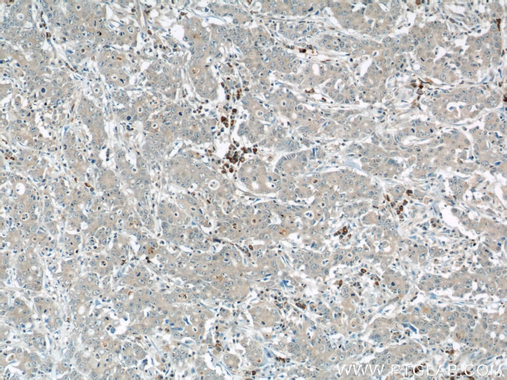 Immunohistochemistry (IHC) staining of human stomach cancer tissue using MMP3 Polyclonal antibody (17873-1-AP)