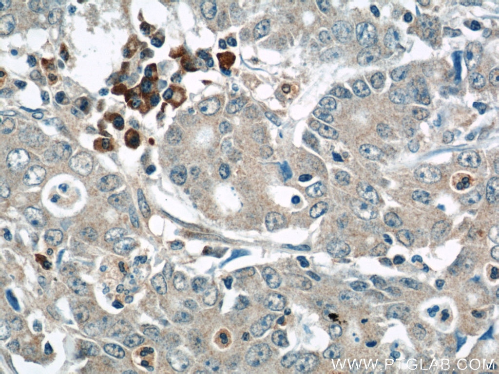 Immunohistochemistry (IHC) staining of human stomach cancer tissue using MMP3 Polyclonal antibody (17873-1-AP)