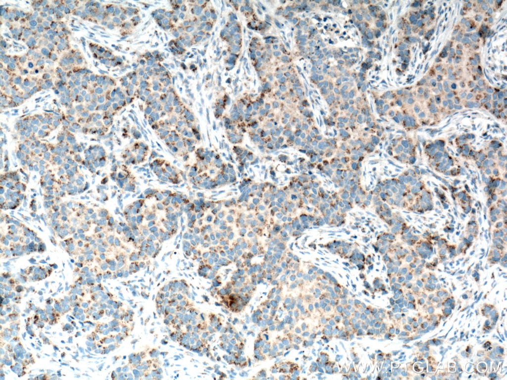 Immunohistochemistry (IHC) staining of human breast cancer tissue using MMP3 Monoclonal antibody (66338-1-Ig)