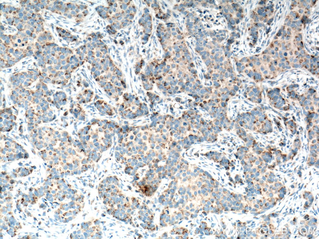 IHC staining of human breast cancer using 66338-1-Ig