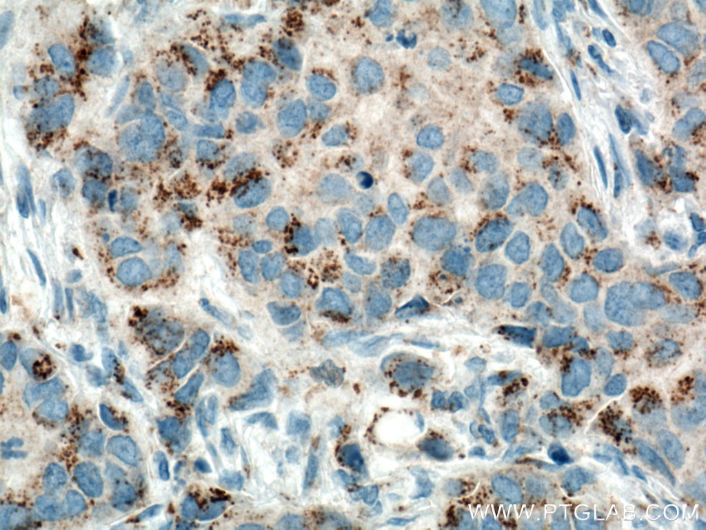 Immunohistochemistry (IHC) staining of human breast cancer tissue using MMP3 Monoclonal antibody (66338-1-Ig)