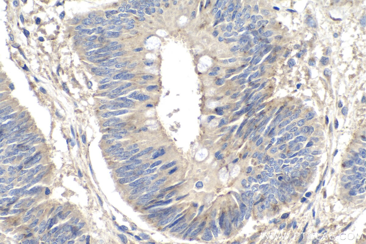 Immunohistochemistry (IHC) staining of human colon cancer tissue using MMP3 Monoclonal antibody (66338-1-Ig)