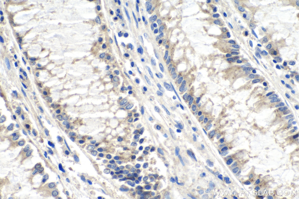 Immunohistochemistry (IHC) staining of human colon cancer tissue using MMP3 Monoclonal antibody (66338-1-Ig)