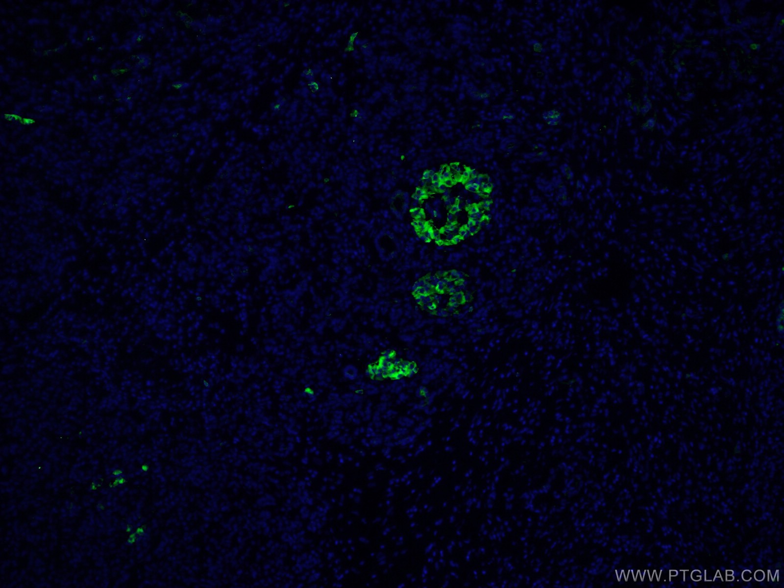 Immunofluorescence (IF) / fluorescent staining of human pancreas cancer tissue using MMP7 Polyclonal antibody (10374-2-AP)