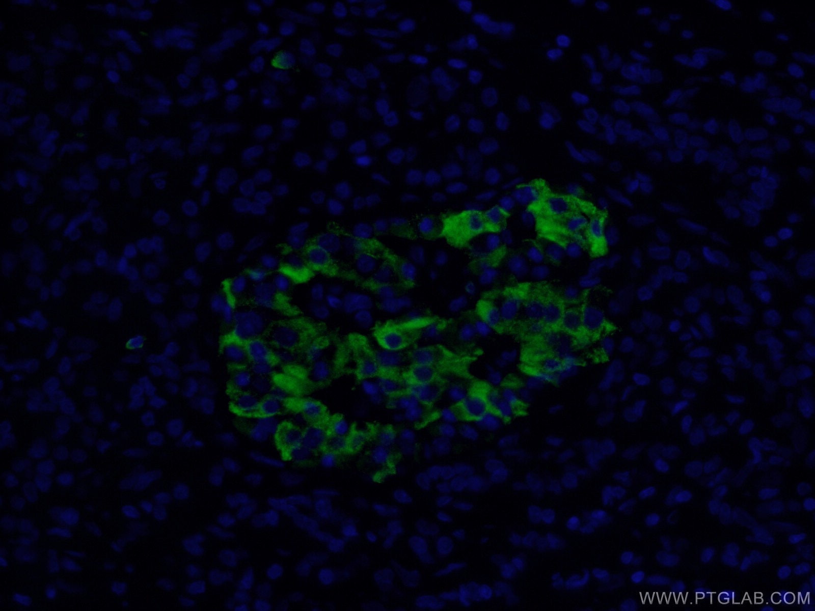 Immunofluorescence (IF) / fluorescent staining of human pancreas cancer tissue using MMP7 Polyclonal antibody (10374-2-AP)