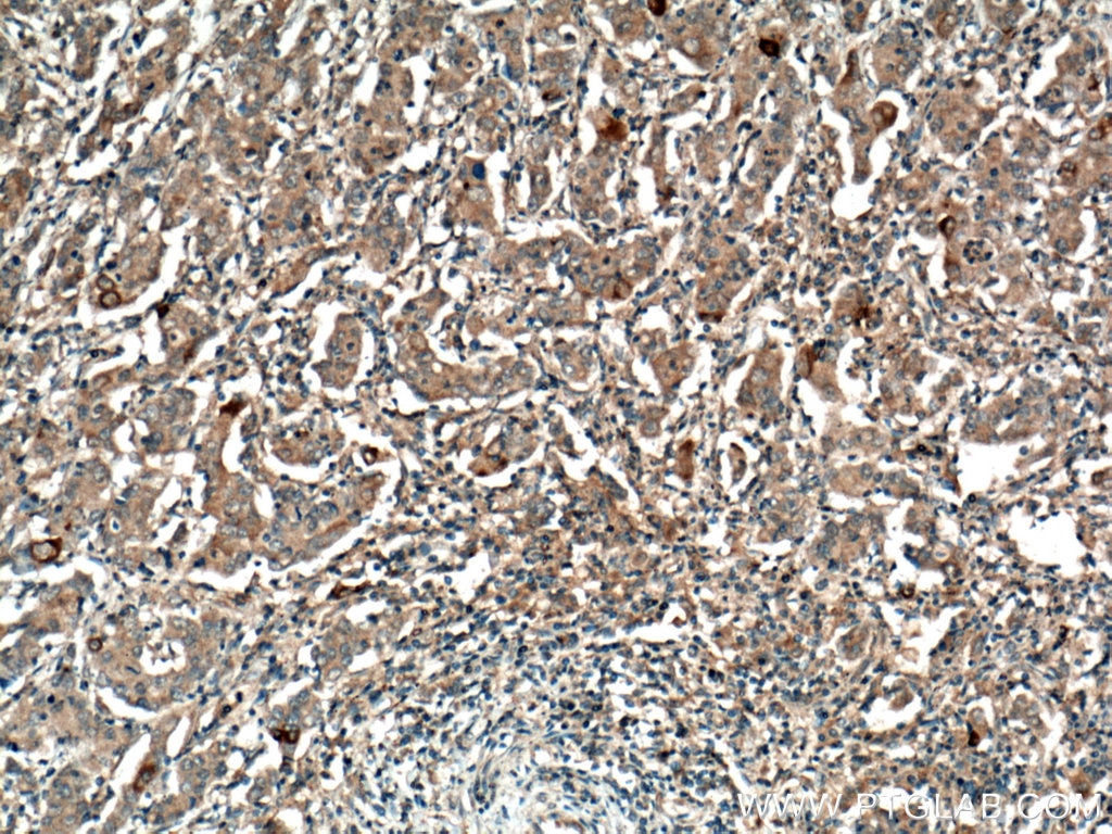 Immunohistochemistry (IHC) staining of human stomach cancer tissue using MMP7 Polyclonal antibody (10374-2-AP)