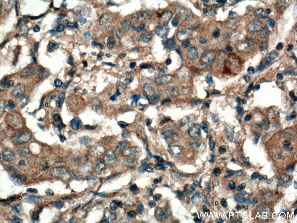 Immunohistochemistry (IHC) staining of human stomach cancer tissue using MMP7 Polyclonal antibody (10374-2-AP)