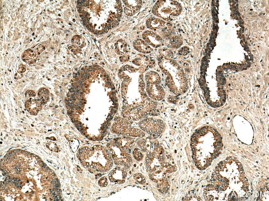 Immunohistochemistry (IHC) staining of human prostate cancer tissue using MMP7 Polyclonal antibody (10374-2-AP)
