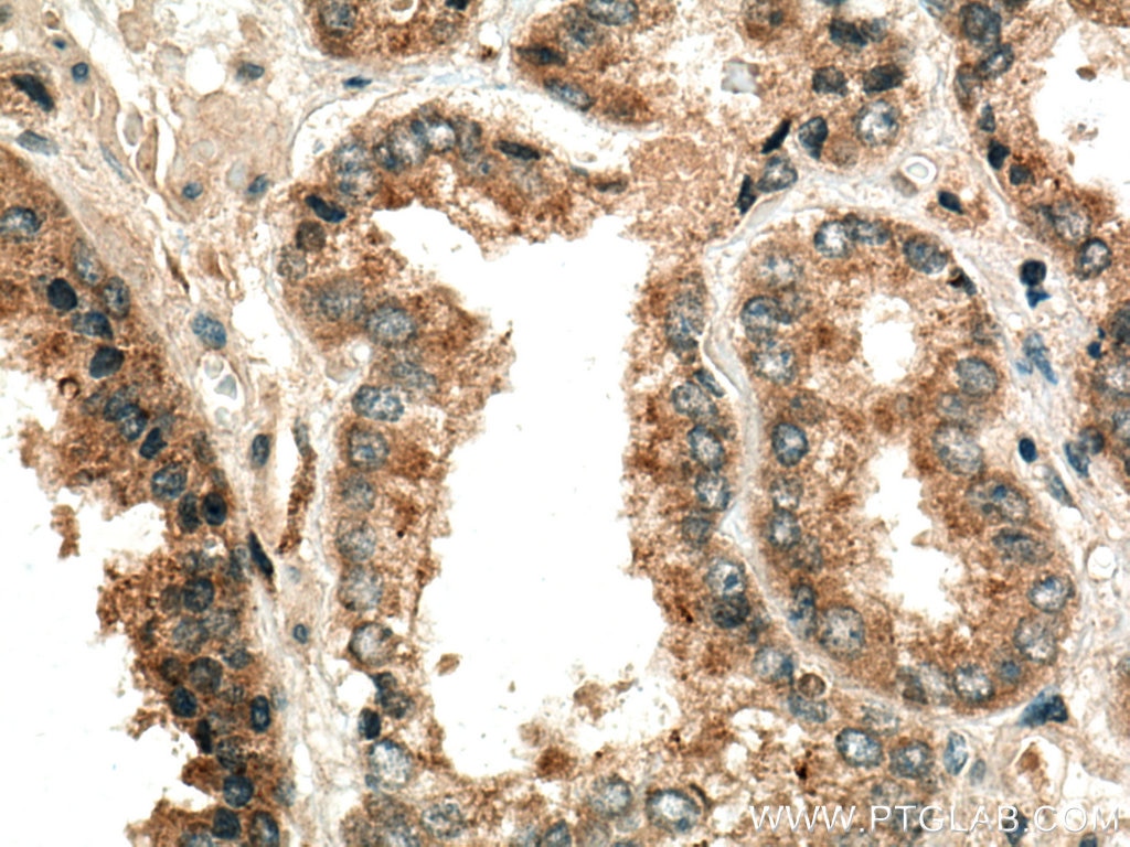 Immunohistochemistry (IHC) staining of human prostate cancer tissue using MMP7 Polyclonal antibody (10374-2-AP)