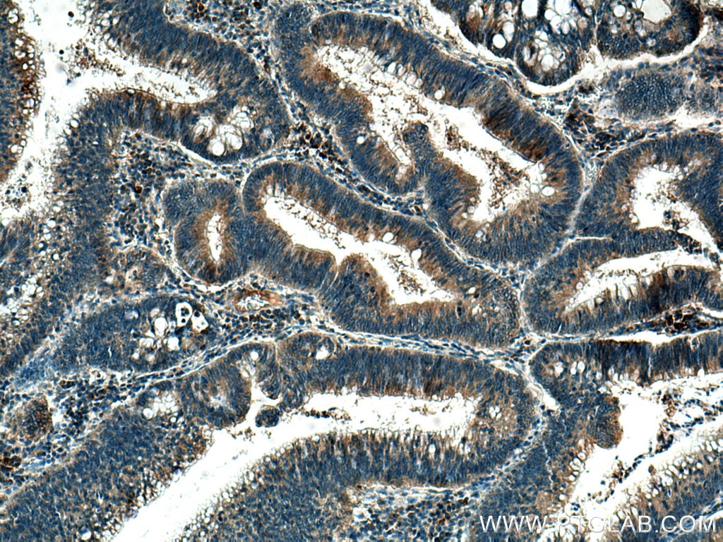 Immunohistochemistry (IHC) staining of human colon cancer tissue using MMP7 Polyclonal antibody (10374-2-AP)