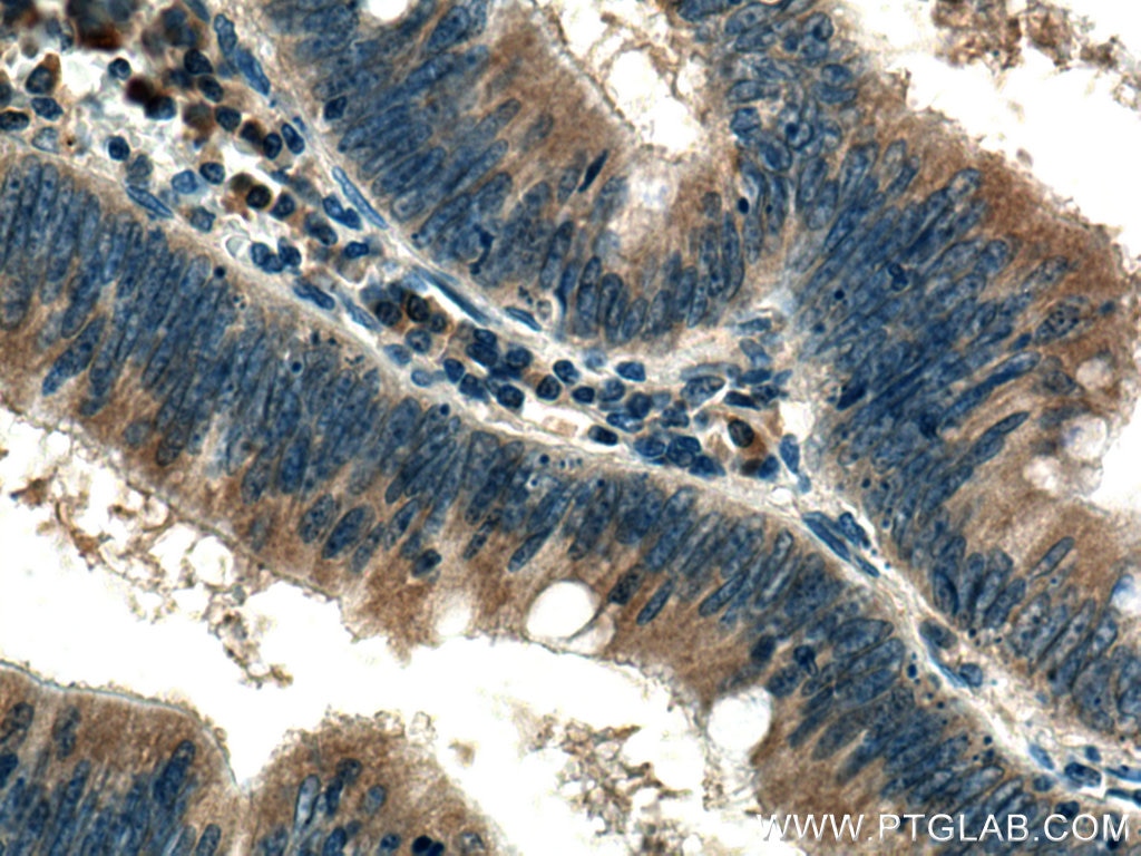 Immunohistochemistry (IHC) staining of human colon cancer tissue using MMP7 Polyclonal antibody (10374-2-AP)