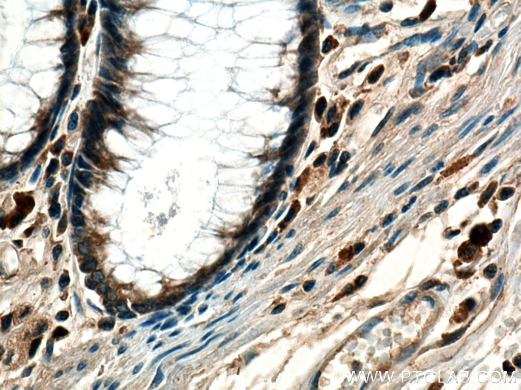 Immunohistochemistry (IHC) staining of human colon cancer tissue using MMP7 Polyclonal antibody (10374-2-AP)