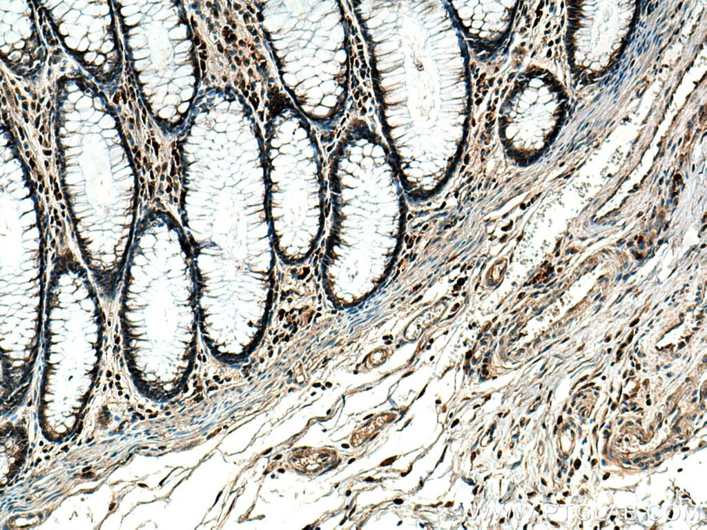 IHC staining of human colon cancer using 10374-2-AP