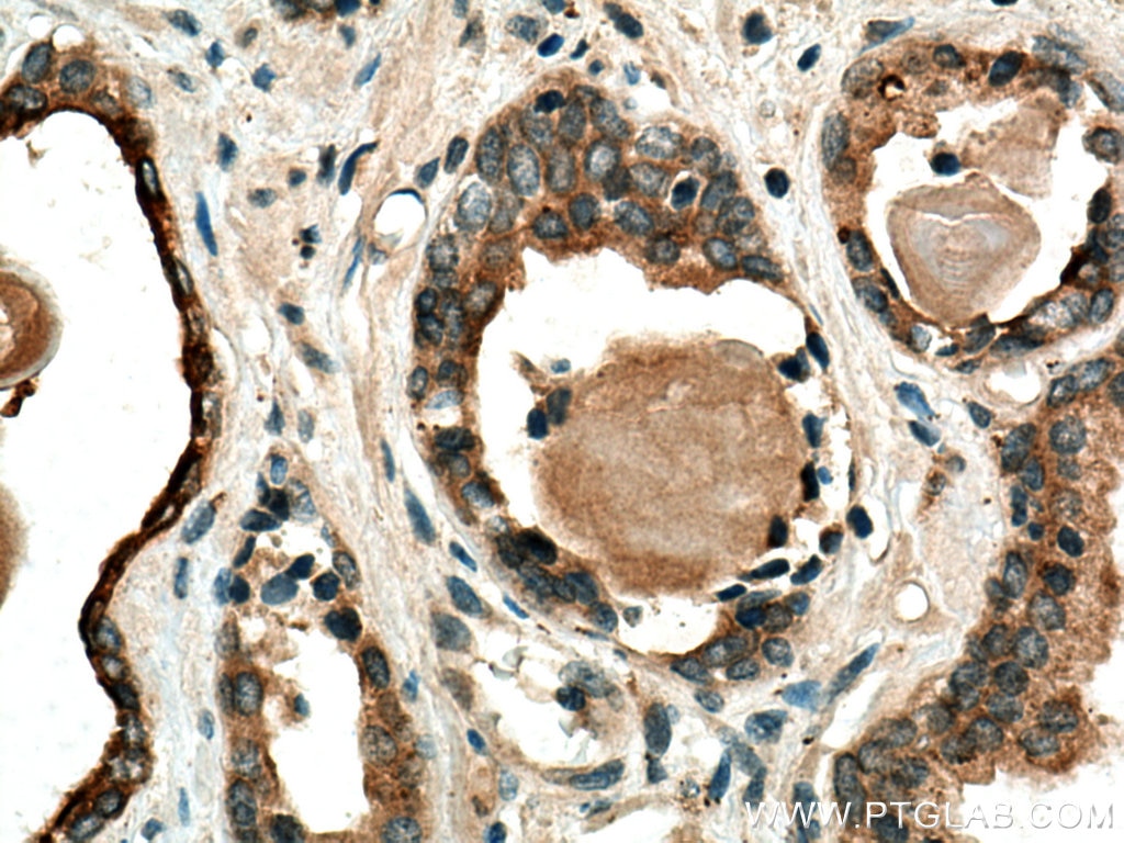 IHC staining of human prostate cancer using 10374-2-AP