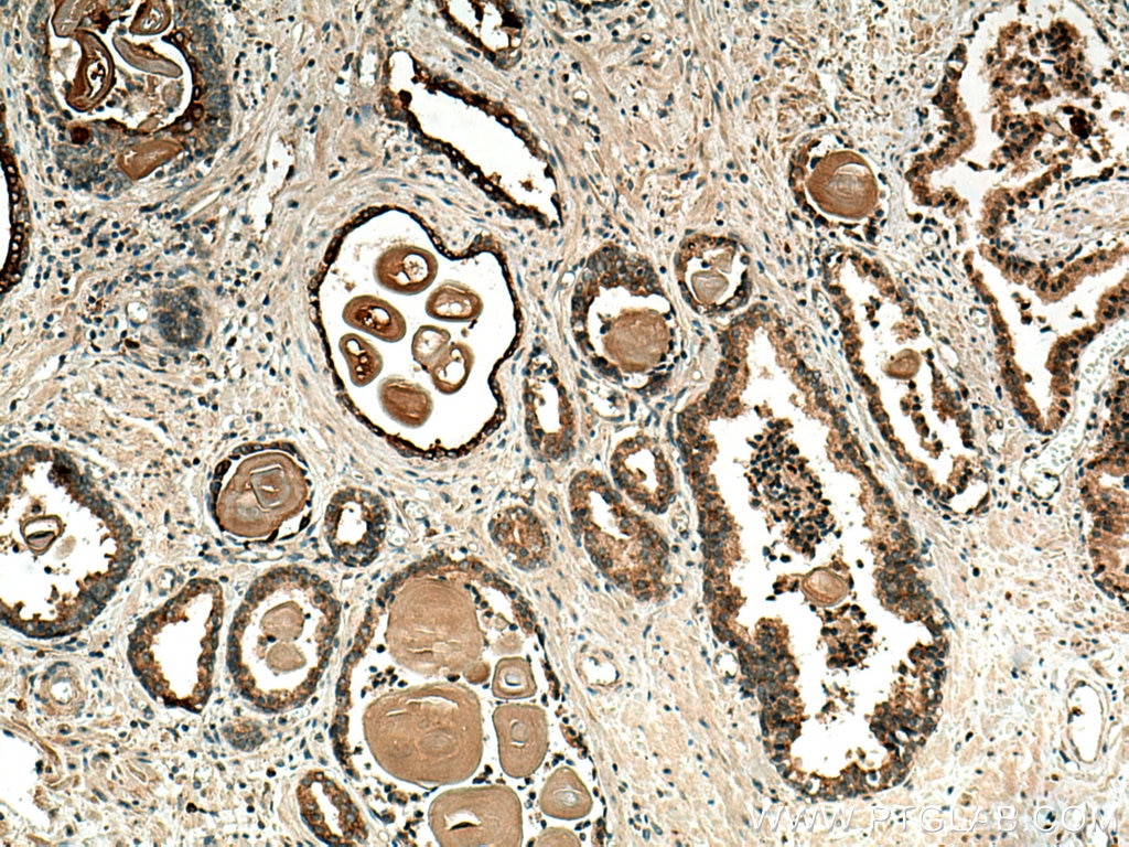 Immunohistochemistry (IHC) staining of human prostate cancer tissue using MMP7 Polyclonal antibody (10374-2-AP)