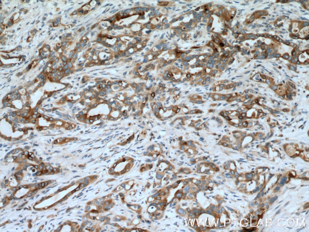 Immunohistochemistry (IHC) staining of human pancreas cancer tissue using MMP7 Polyclonal antibody (10374-2-AP)