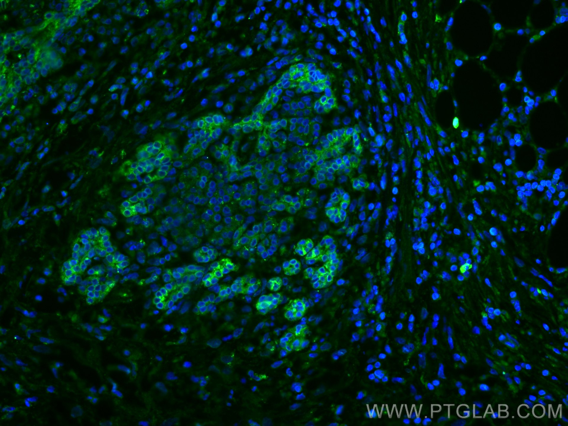 Immunofluorescence (IF) / fluorescent staining of human pancreas cancer tissue using MMP7 Monoclonal antibody (67990-1-Ig)