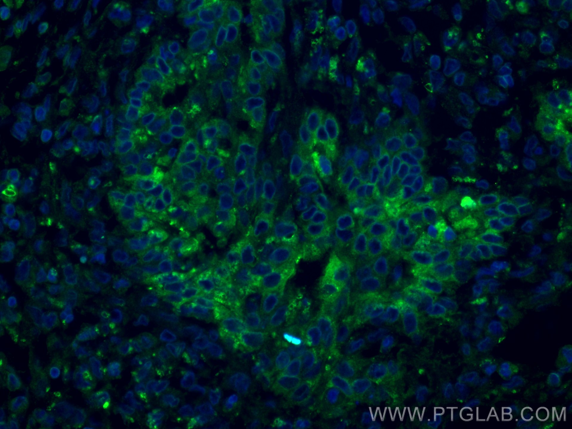 Immunofluorescence (IF) / fluorescent staining of human pancreas cancer tissue using MMP7 Monoclonal antibody (67990-1-Ig)