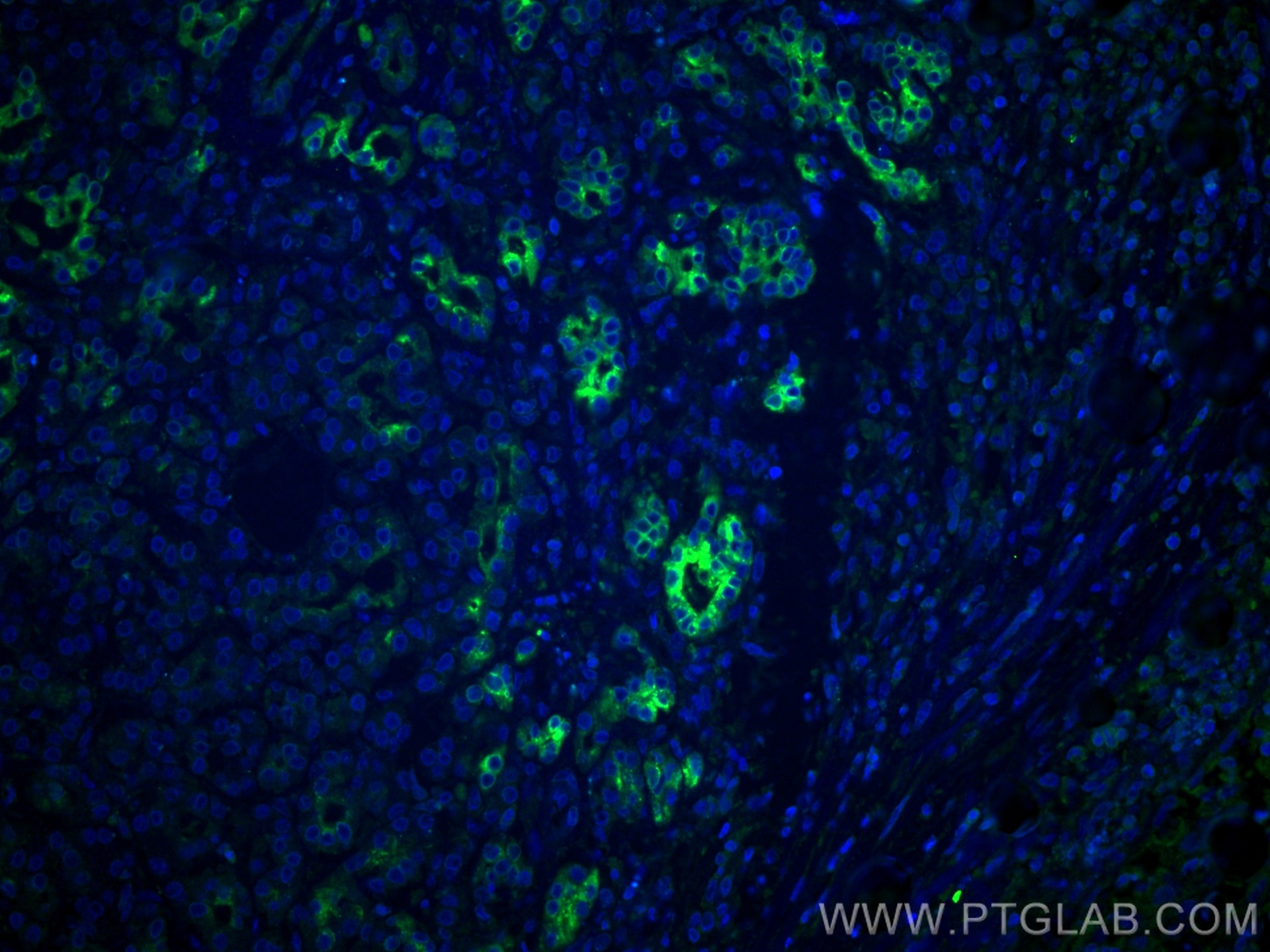 Immunofluorescence (IF) / fluorescent staining of human pancreas cancer tissue using MMP7 Monoclonal antibody (67990-1-Ig)