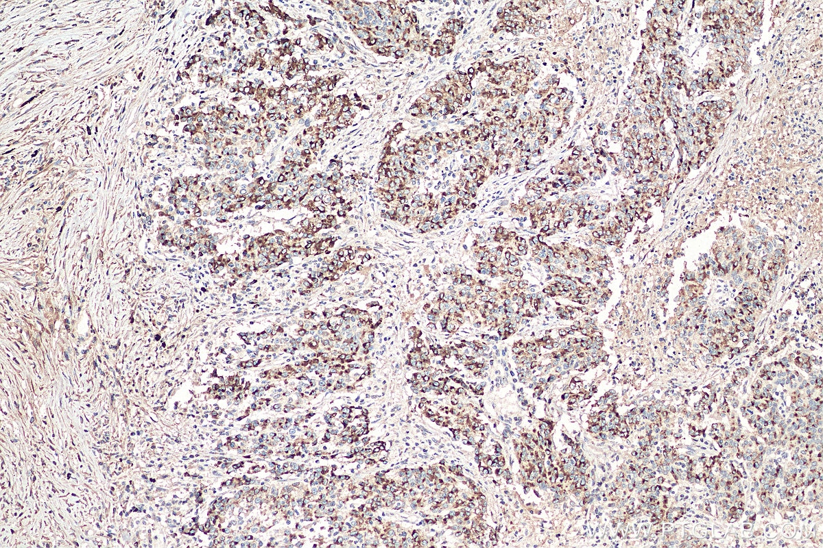 Immunohistochemistry (IHC) staining of human stomach cancer tissue using MMP7 Monoclonal antibody (67990-1-Ig)