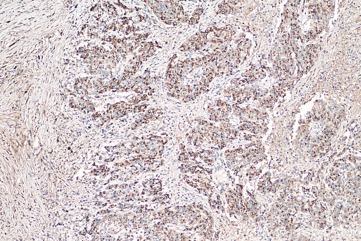 IHC staining of human stomach cancer using 67990-1-Ig