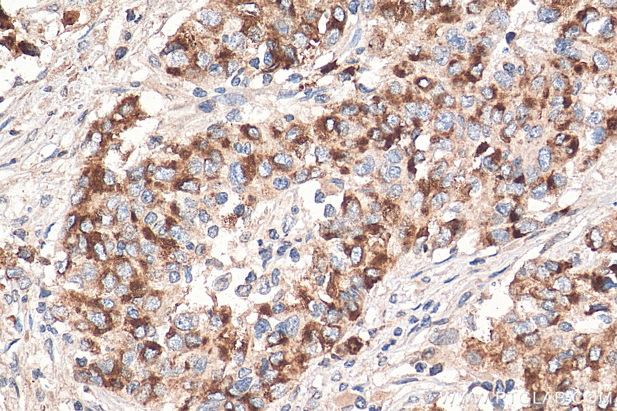 Immunohistochemistry (IHC) staining of human stomach cancer tissue using MMP7 Monoclonal antibody (67990-1-Ig)