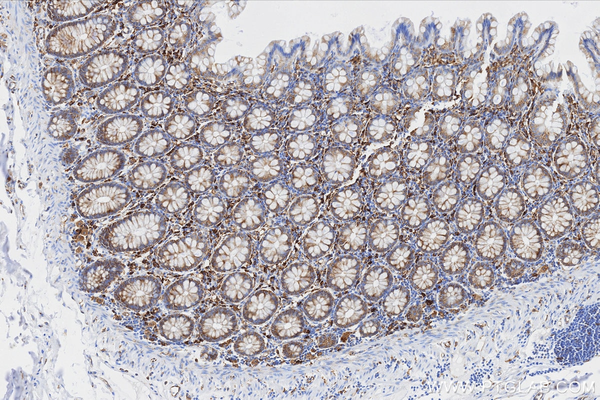 Immunohistochemistry (IHC) staining of human colon tissue using MMP7 Recombinant monoclonal antibody (87552-1-RR)