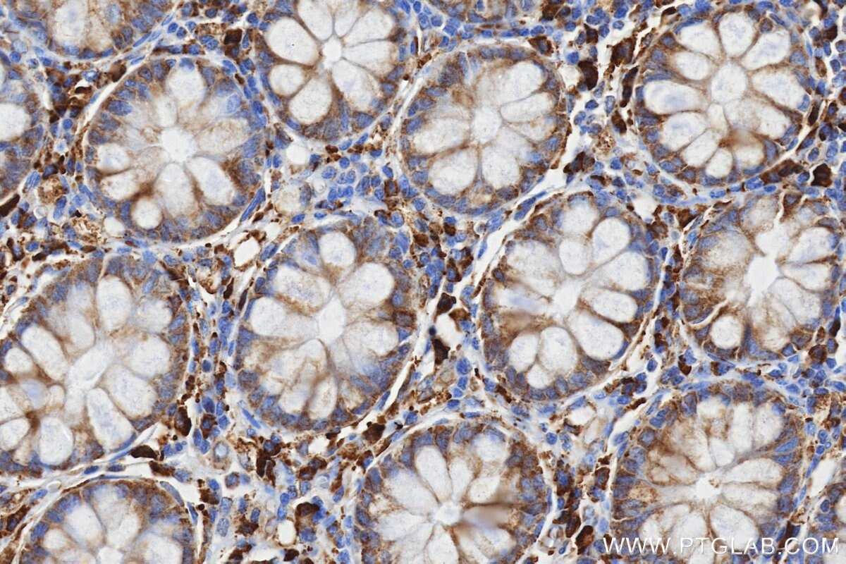 Immunohistochemistry (IHC) staining of human colon tissue using MMP7 Recombinant monoclonal antibody (87552-1-RR)