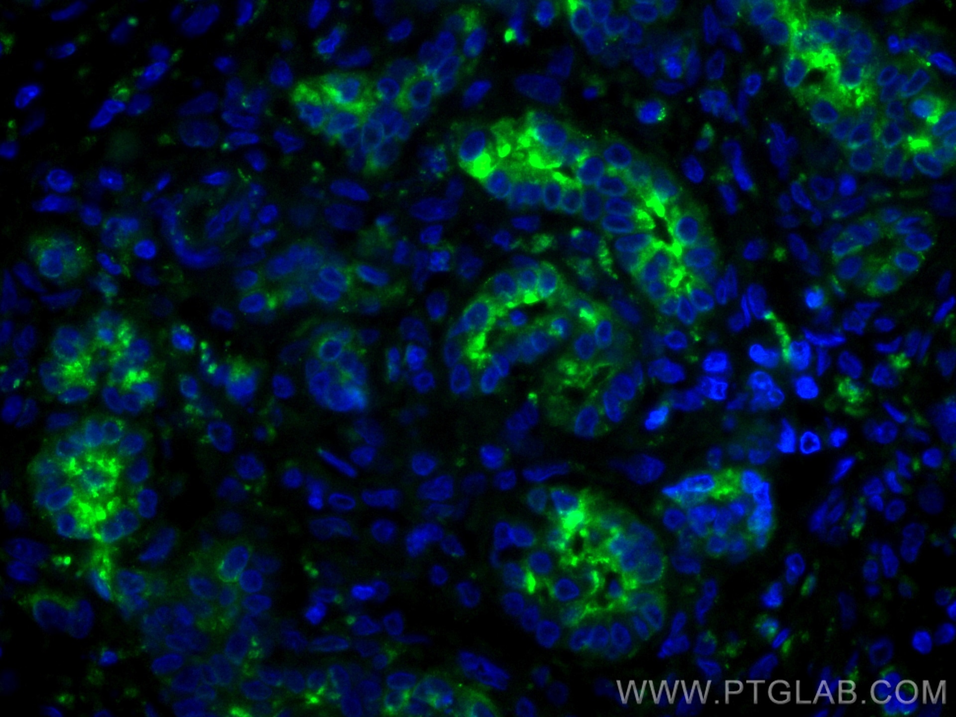 Immunofluorescence (IF) / fluorescent staining of human pancreas cancer tissue using CoraLite® Plus 488-conjugated MMP7 Monoclonal anti (CL488-67990)