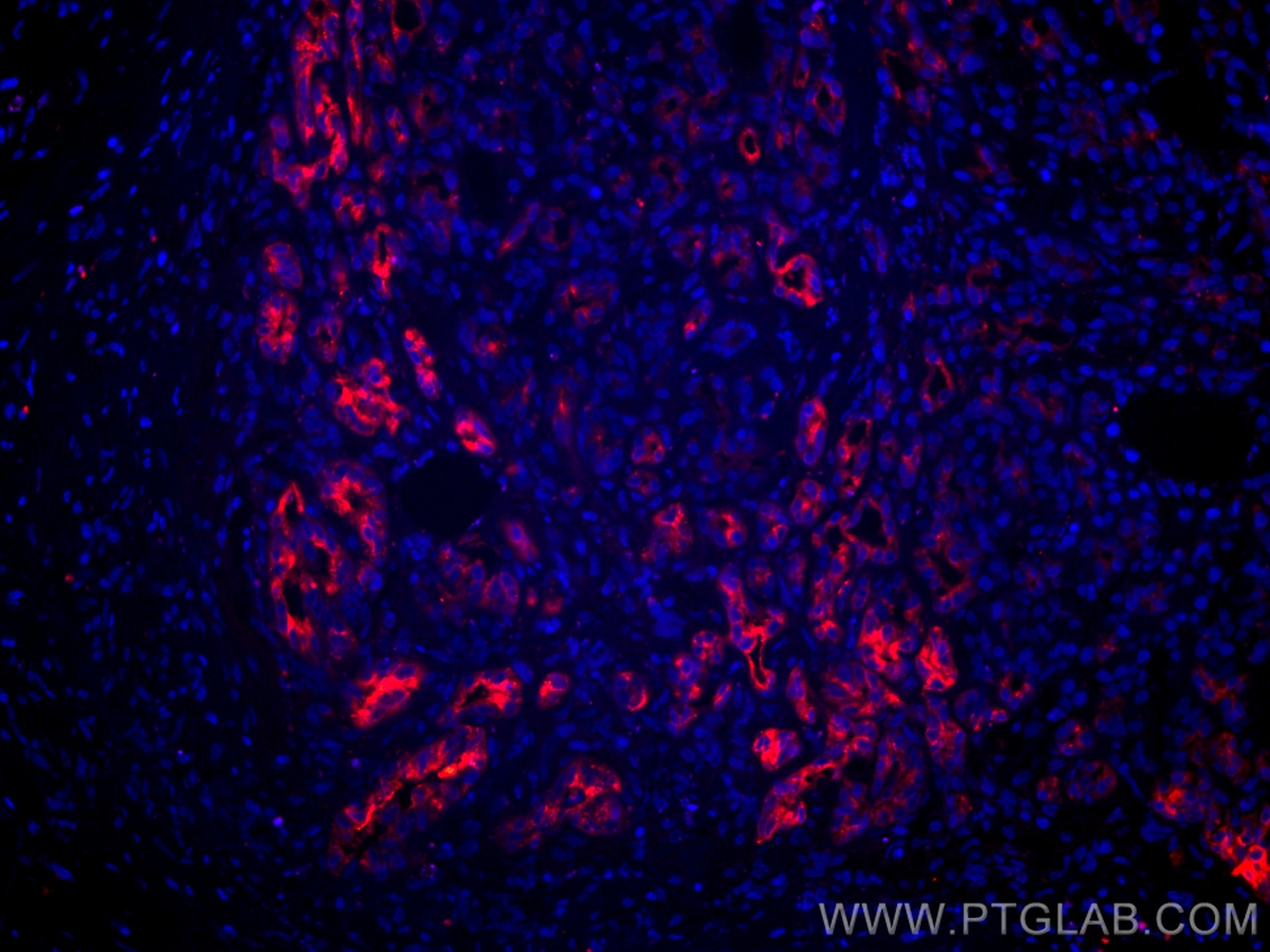 Immunofluorescence (IF) / fluorescent staining of human pancreas cancer tissue using CoraLite®594-conjugated MMP7 Monoclonal antibody (CL594-67990)