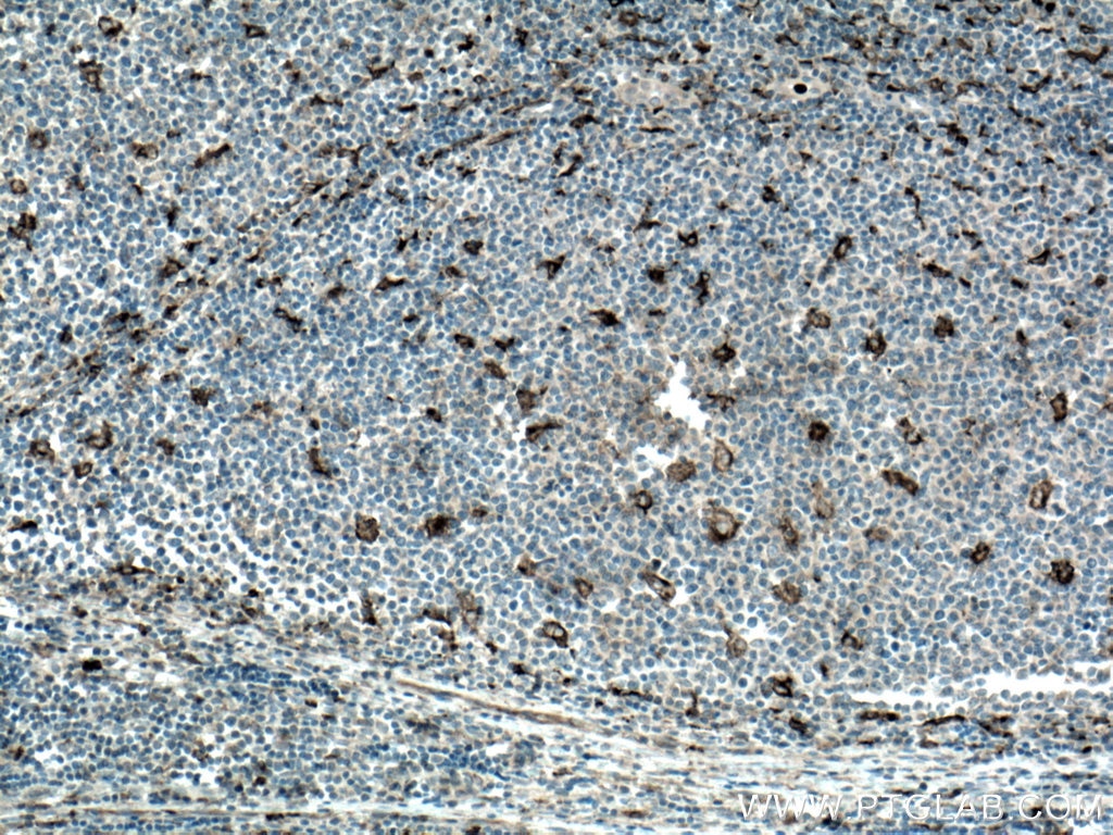 Immunohistochemistry (IHC) staining of human tonsillitis tissue using MMP9 (Middle) Polyclonal antibody (27306-1-AP)