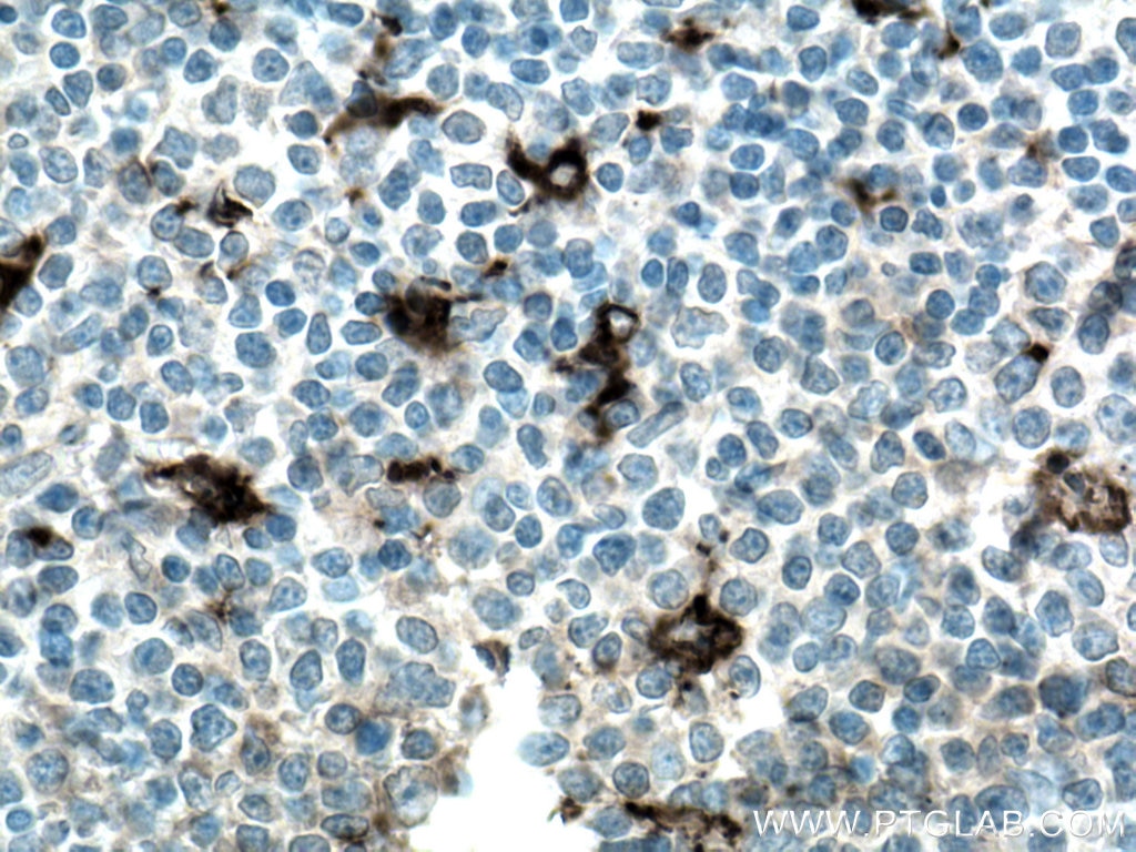 Immunohistochemistry (IHC) staining of human tonsillitis tissue using MMP9 (Middle) Polyclonal antibody (27306-1-AP)