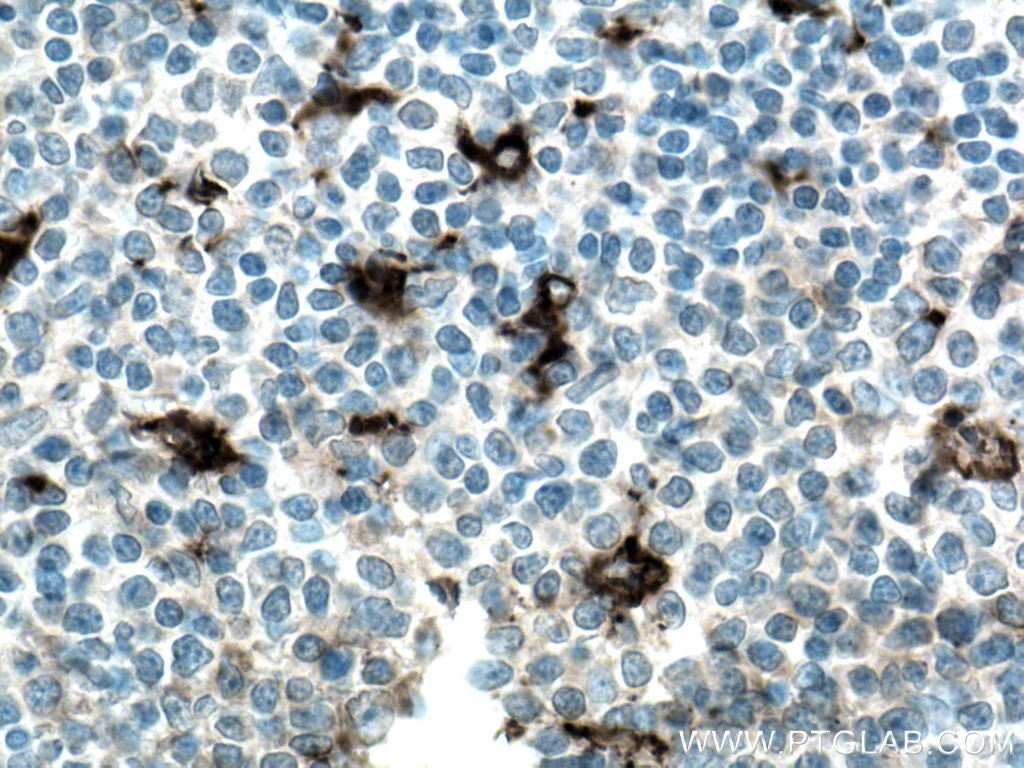 IHC staining of human tonsillitis using 27306-1-AP