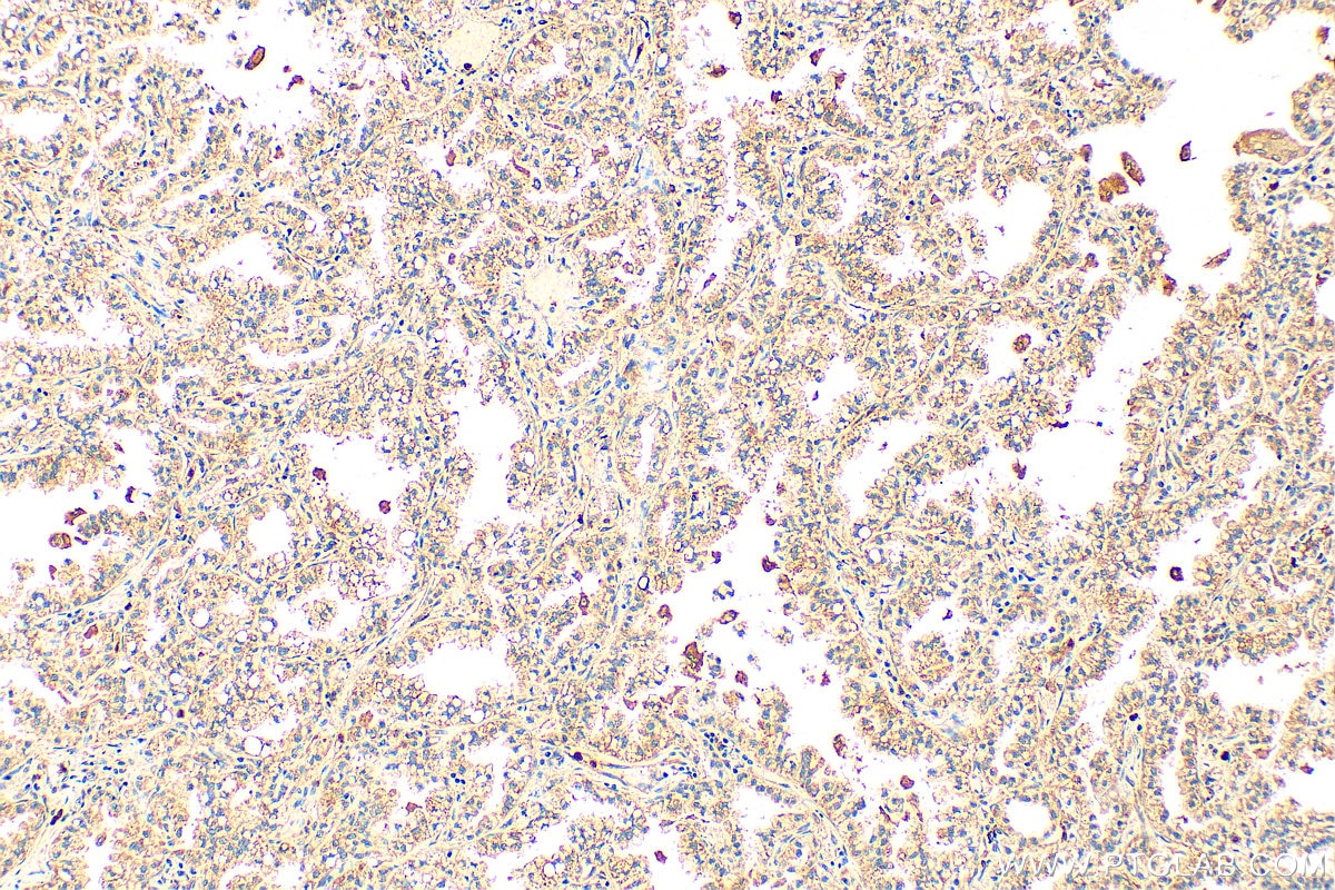 Immunohistochemistry (IHC) staining of human lung cancer tissue using MMP9 (Middle) Polyclonal antibody (27306-1-AP)