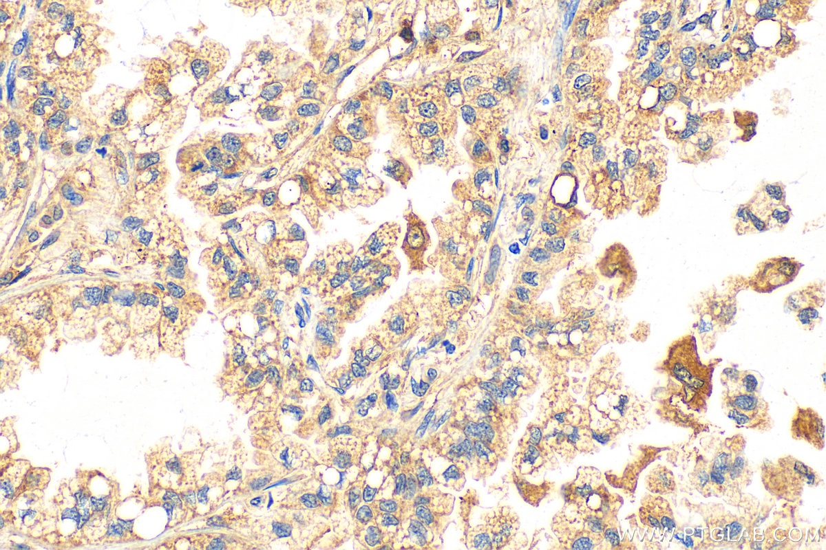 Immunohistochemistry (IHC) staining of human lung cancer tissue using MMP9 (Middle) Polyclonal antibody (27306-1-AP)