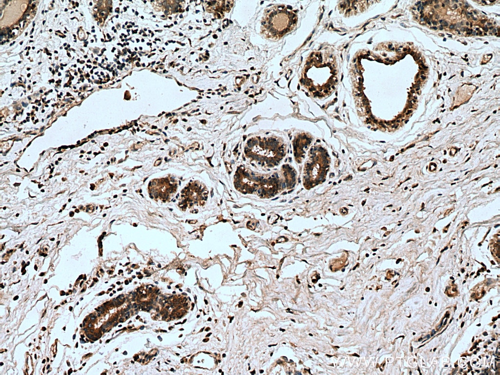 Immunohistochemistry (IHC) staining of human breast cancer tissue using MMP9 (N-terminal) Polyclonal antibody (10375-2-AP)