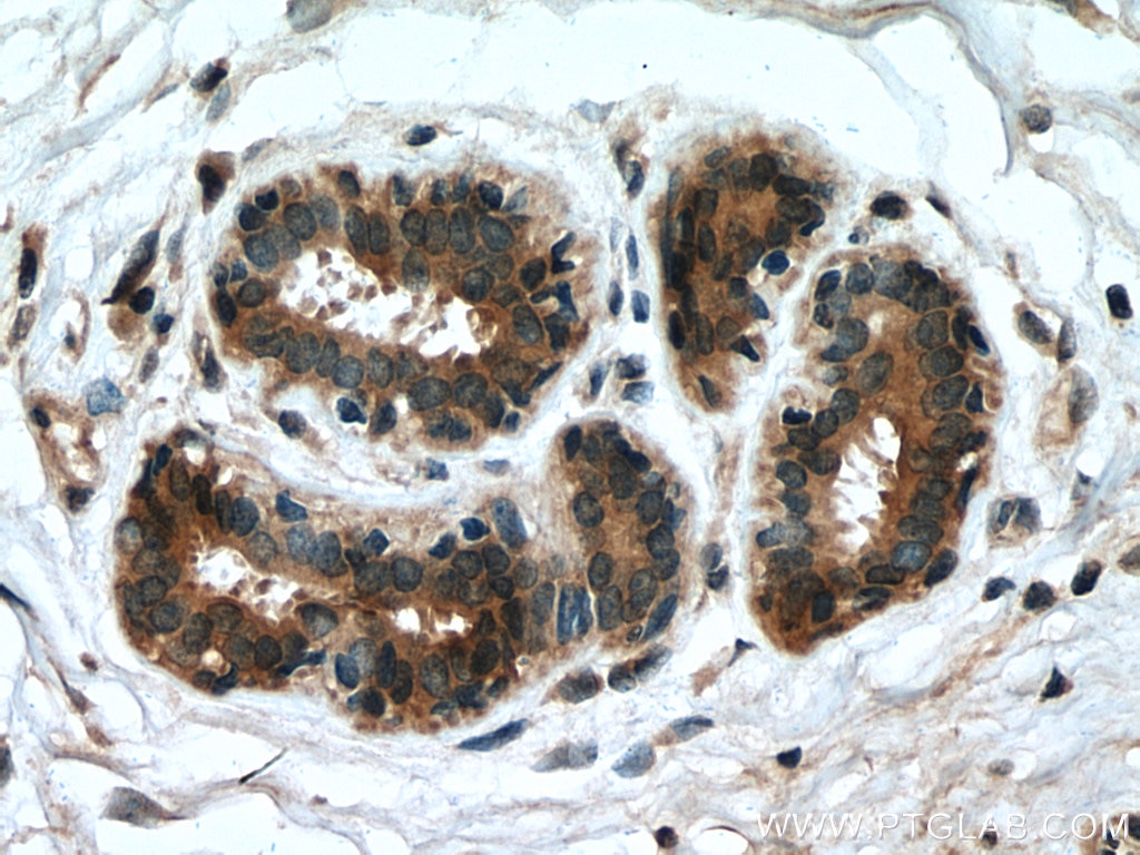 Immunohistochemistry (IHC) staining of human breast cancer tissue using MMP9 (N-terminal) Polyclonal antibody (10375-2-AP)